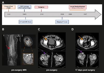 Case report: Solitary mass of the sciatic nerve confirmed as a primary extranodal manifestation of diffuse large B-cell lymphoma in a geriatric patient